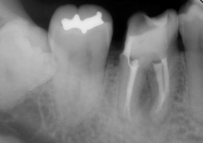 歯の根の病気でも諦めなければ抜歯をしなくても良いかも 根管治療なら岩手県盛岡市のたかデンタルクリニック