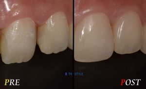 ダイレクトベニア1